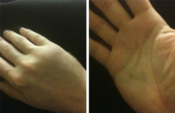 Front and Back of my hand with fractured fifth metacarpal