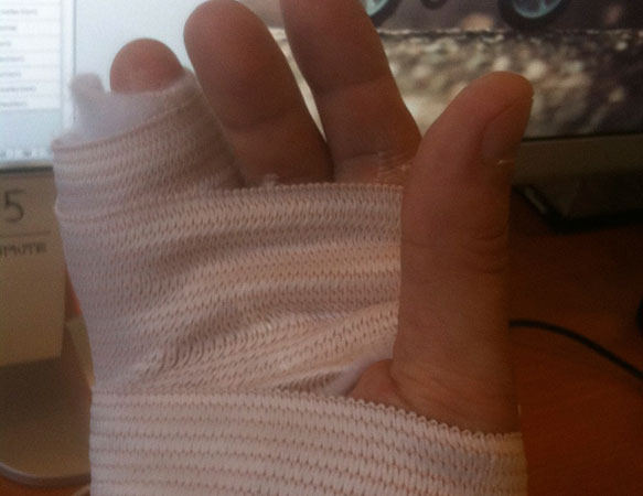 My awesome new splint